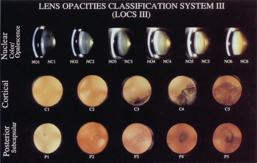 Lens Opacities Classification System III (LOCSIII) EyeKnow O.D.